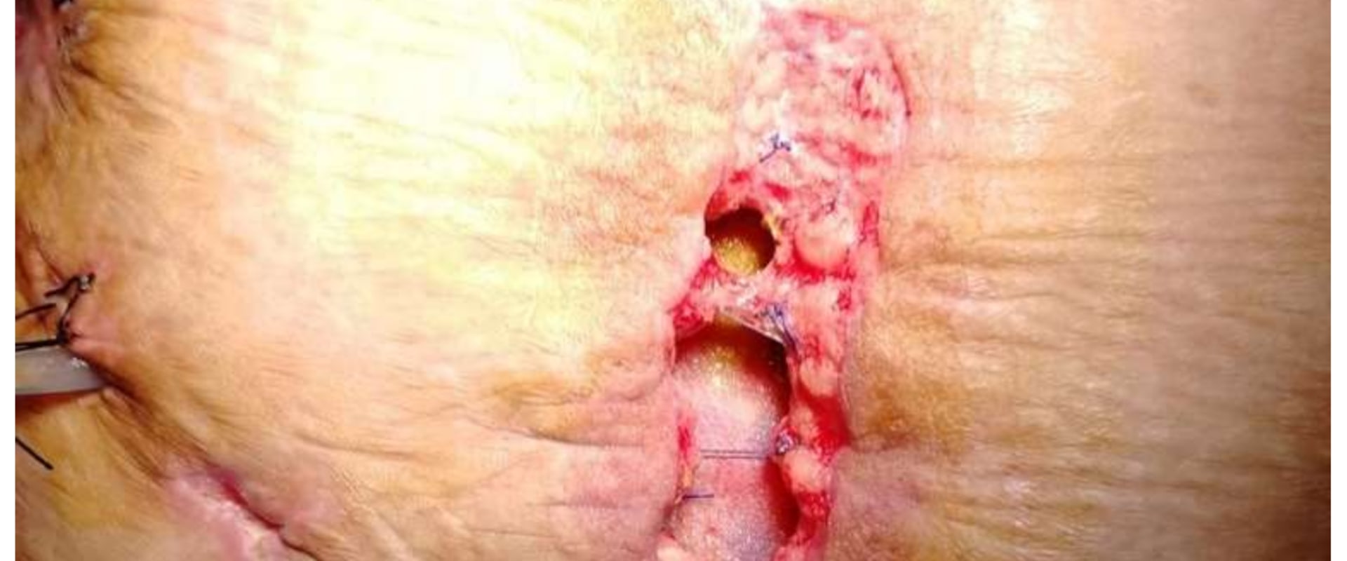 The Truth About Wound VAC Therapy: Why It Can Be Painful and How to Manage It