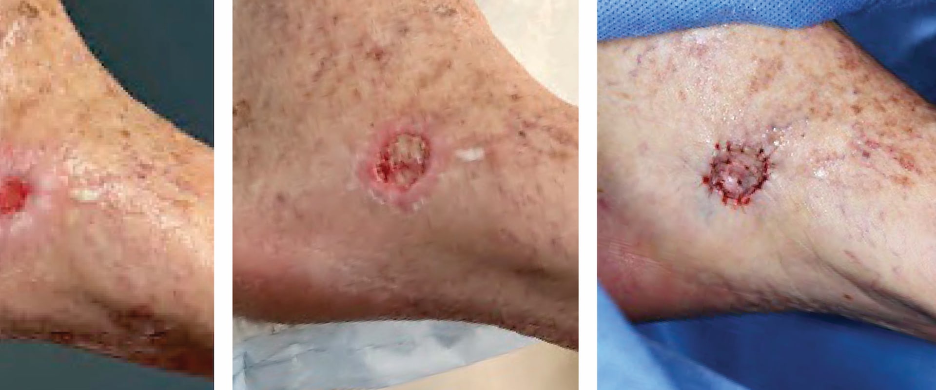 The Revolutionary Healing Power of Vacuum-Assisted Wound Closure