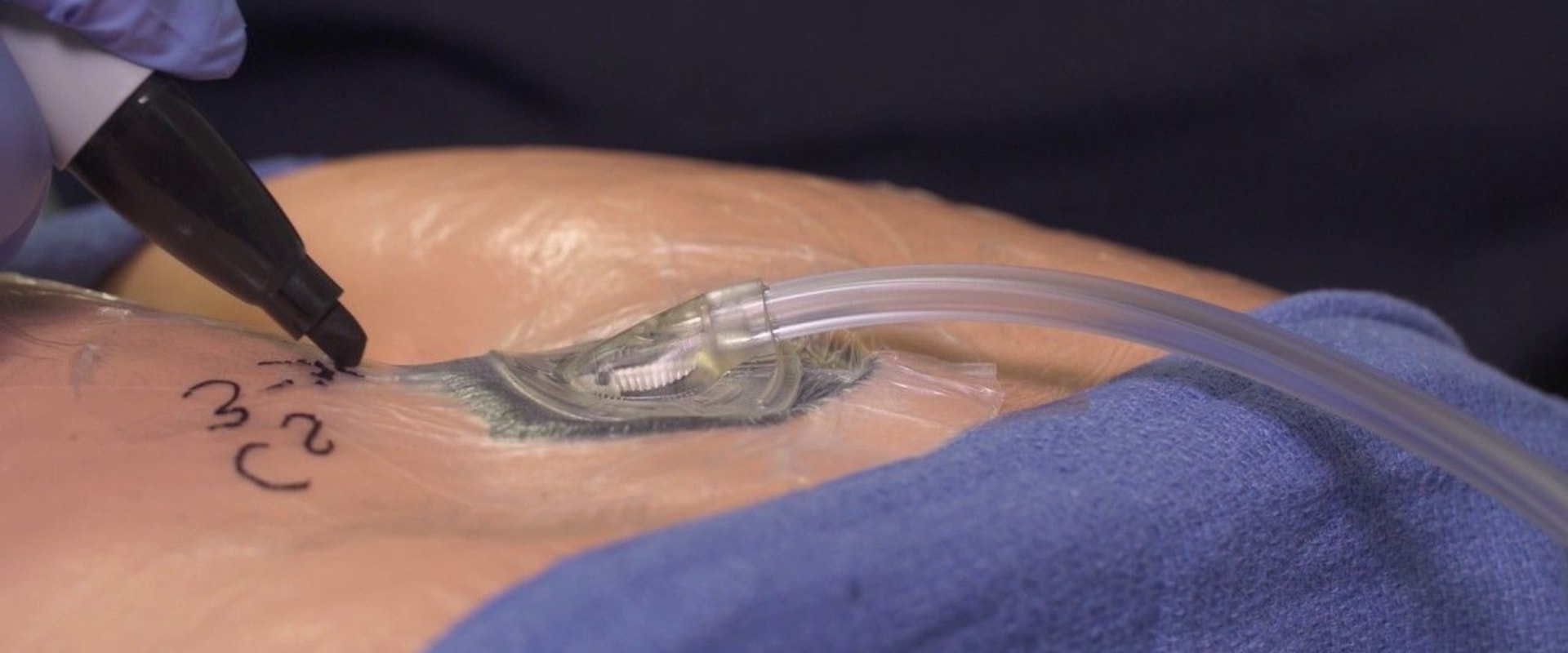 The Revolutionary Wound Vac: A Game-Changing Treatment for Wounds