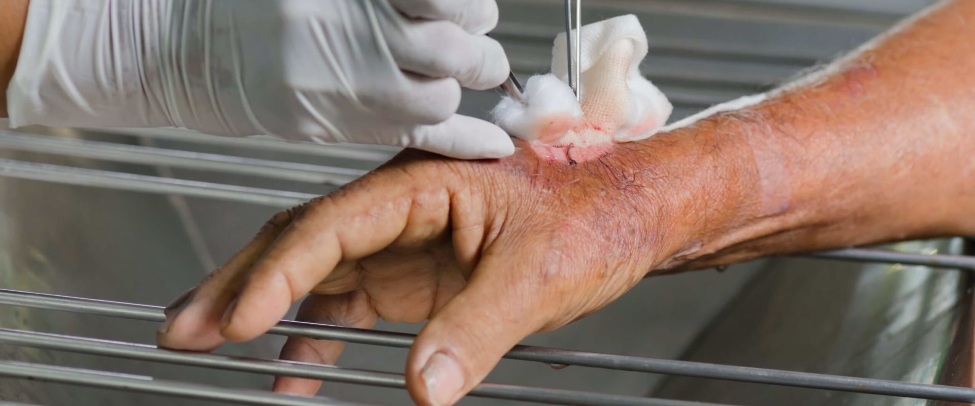 How Enzymatic Debridement Works: Is It the Future of Wound Care?