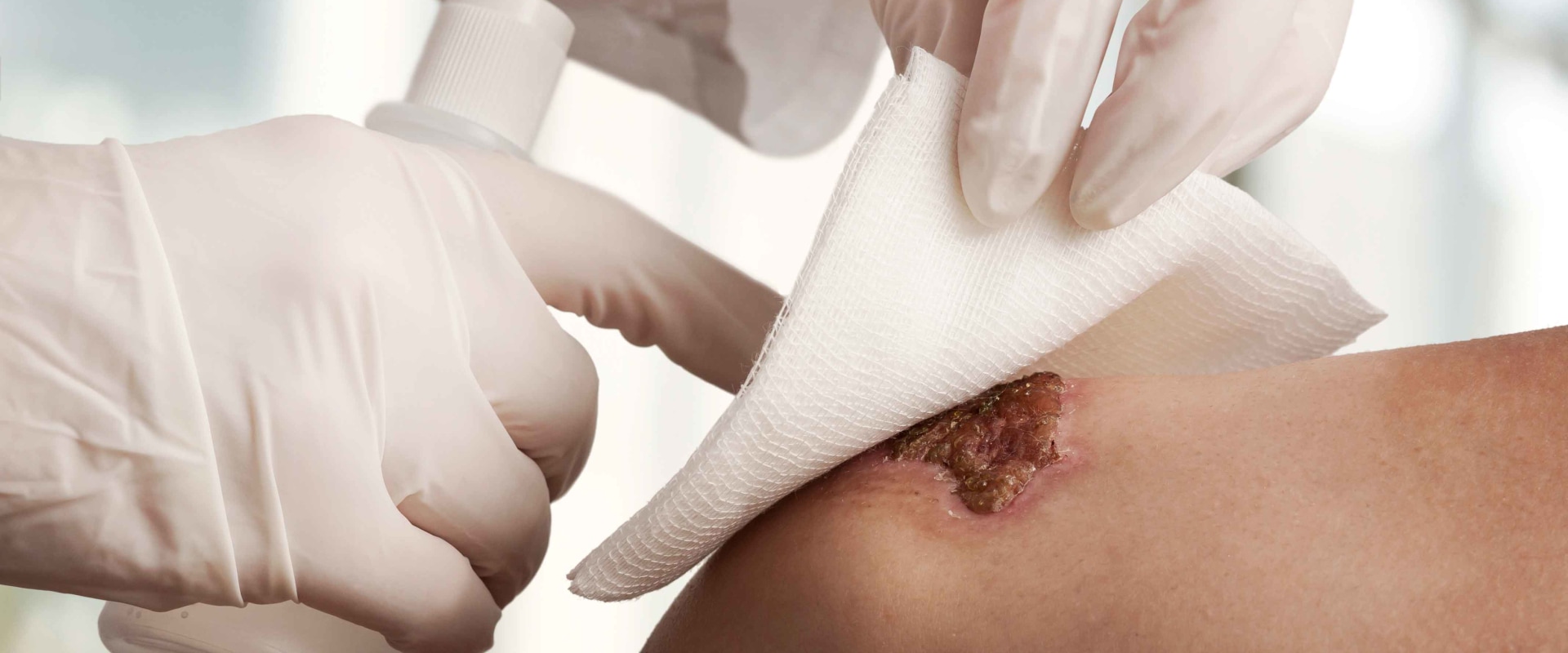 The Impact of Collagen Wound Dressing Side Effects In Wound Vac Care