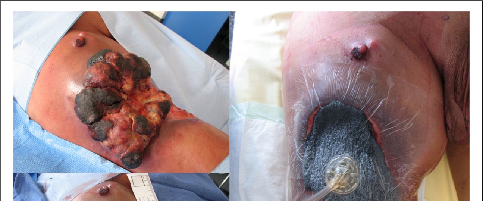 The Power of Negative Pressure Wound Therapy in Healing Various Wounds