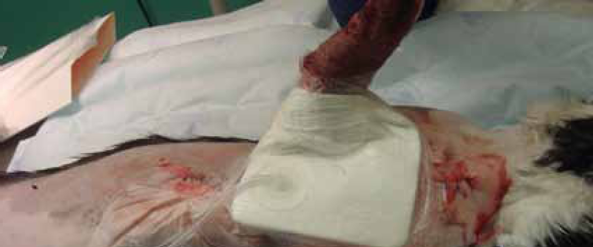 The Advancements and Appropriate Use of Vacuum-Assisted Wound Closure