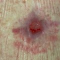 When to Discontinue Negative Pressure Wound Therapy: An Expert's Guide