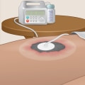 The Power of Negative Pressure Wound Therapy