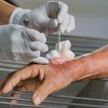 How Enzymatic Debridement Works: Is It the Future of Wound Care?