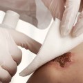 The Impact of Collagen Wound Dressing Side Effects In Wound Vac Care