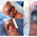 The Power of Negative Pressure Wound Therapy in Healing Various Wounds