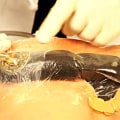 When to Remove Wound Vac: An Expert's Perspective