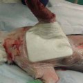 The Advancements and Appropriate Use of Vacuum-Assisted Wound Closure