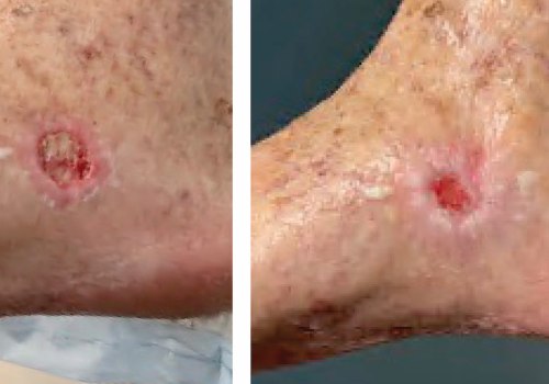 The Revolutionary Healing Power of Vacuum-Assisted Wound Closure