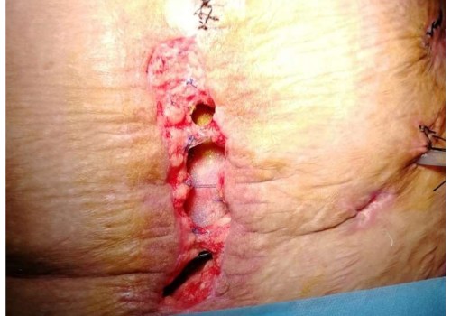 The Truth About Wound Vac Removal: An Expert's Perspective