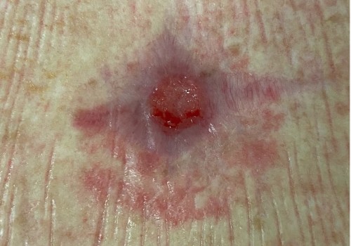 When to Discontinue Negative Pressure Wound Therapy: An Expert's Guide