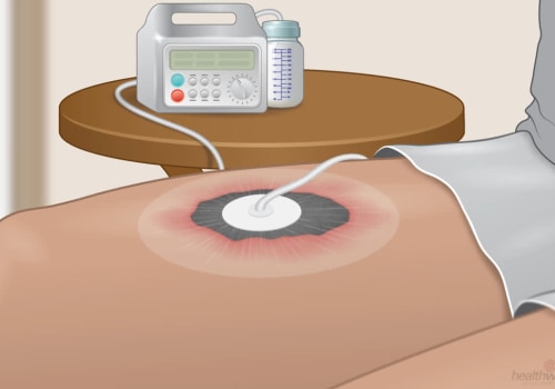 The Power of Negative Pressure Wound Therapy