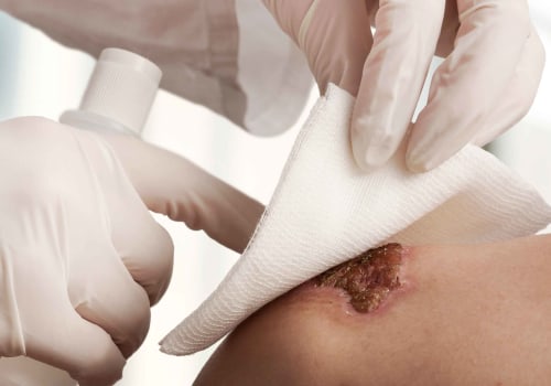 The Impact of Collagen Wound Dressing Side Effects In Wound Vac Care