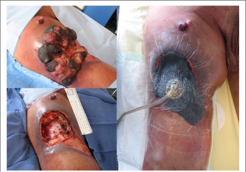 The Power of Negative Pressure Wound Therapy in Healing Various Wounds