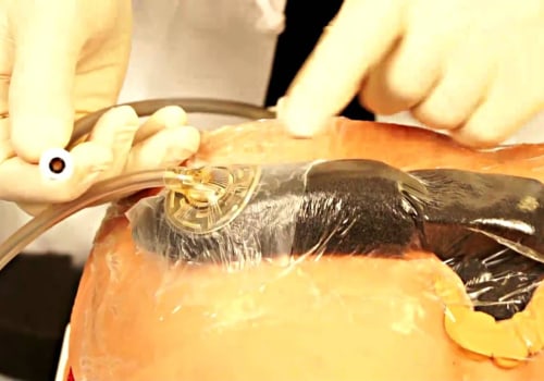 When to Remove Wound Vac: An Expert's Perspective