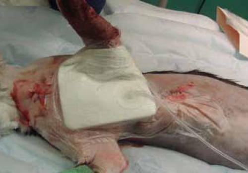 The Advancements and Appropriate Use of Vacuum-Assisted Wound Closure