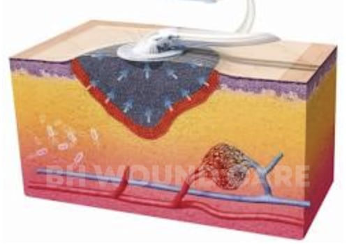 The Revolutionary Healing Power of Vacuum-Assisted Wound Closure